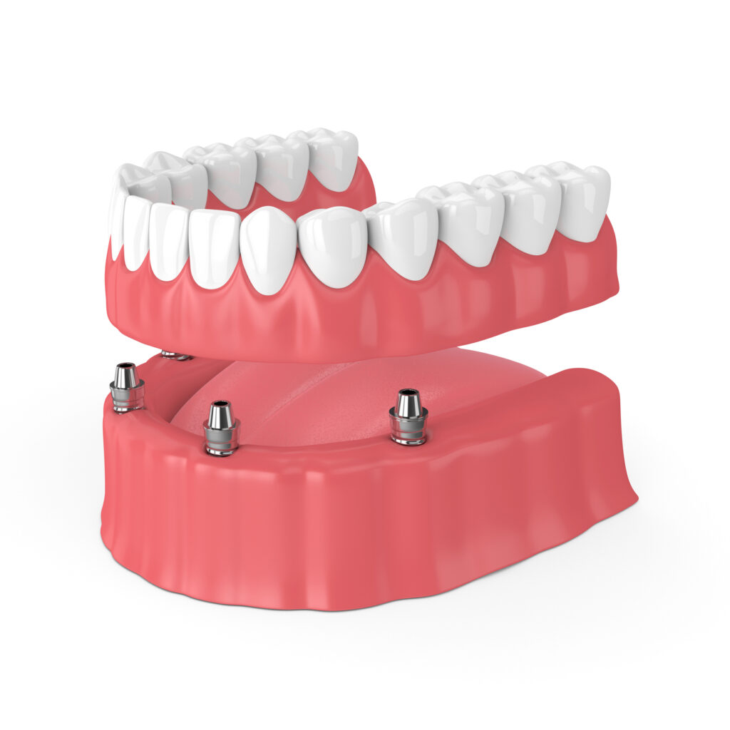 Dental implant dentures illustration